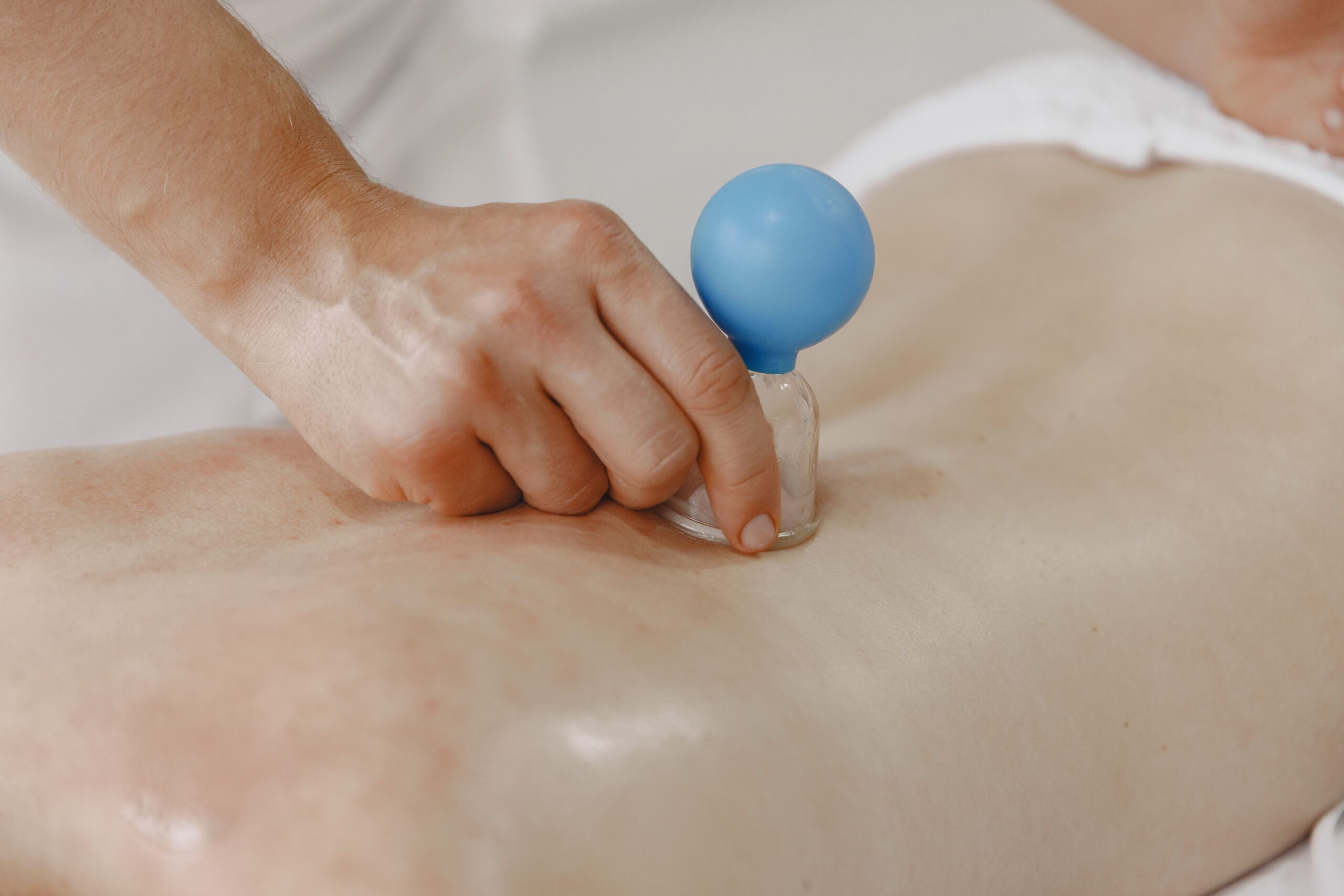 Cupping: what is it and what can it be used for? 1 Cupping treatment with a vacuum cup on the back