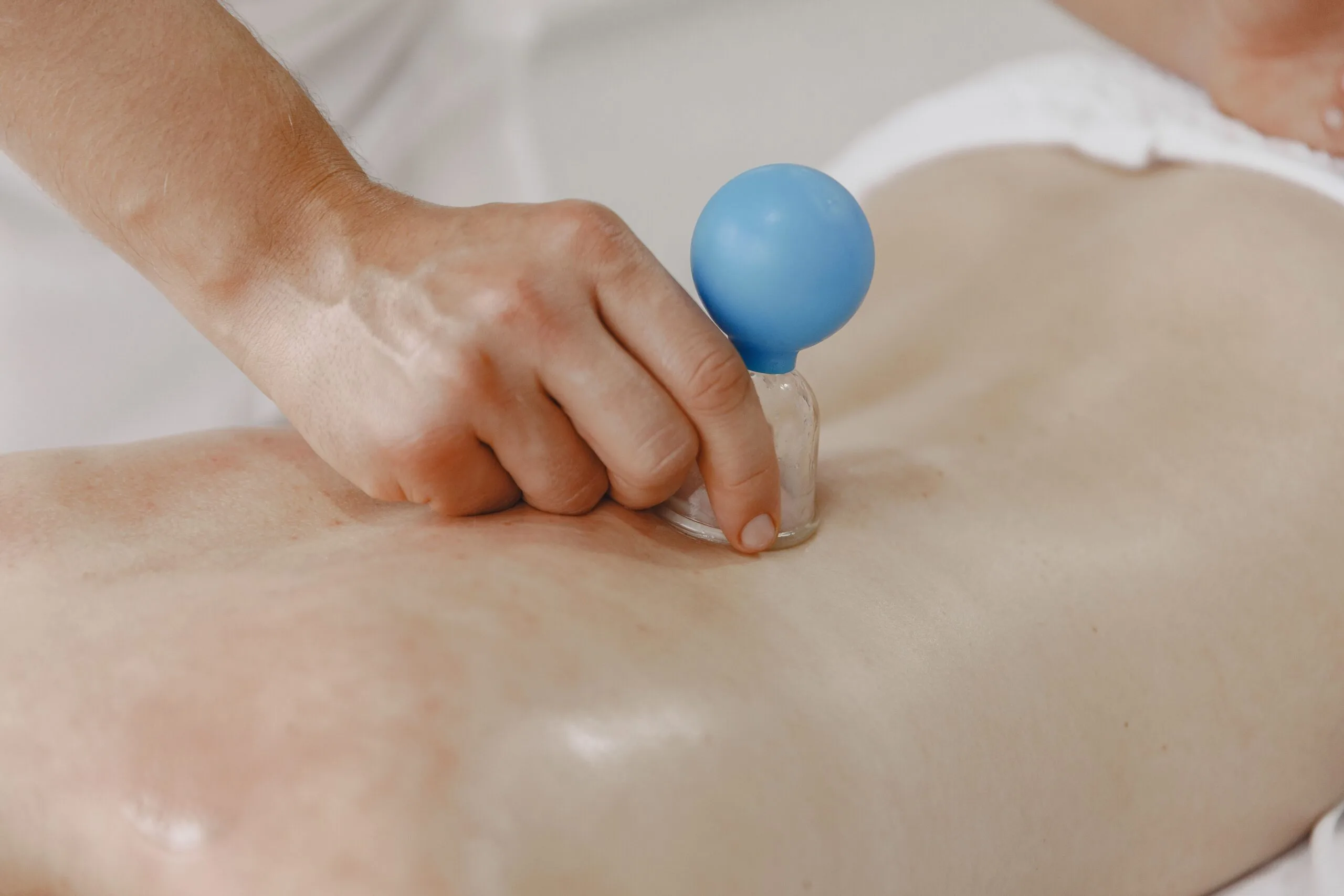 Cupping behandling med vakuumkop på ryggen